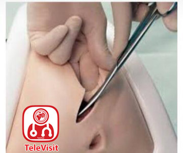 ترمیم بخیه واژن پس از زایمان طبیعی