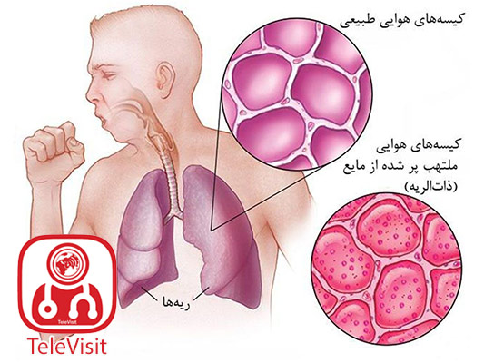 ذات‌الریه چیست و چگونه درمان می‌شود؟