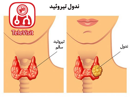 ندول یا گره تیروئید چیست؟