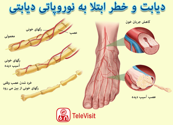 دیابت و خطر ابتلا به نوروپاتی دیابتی