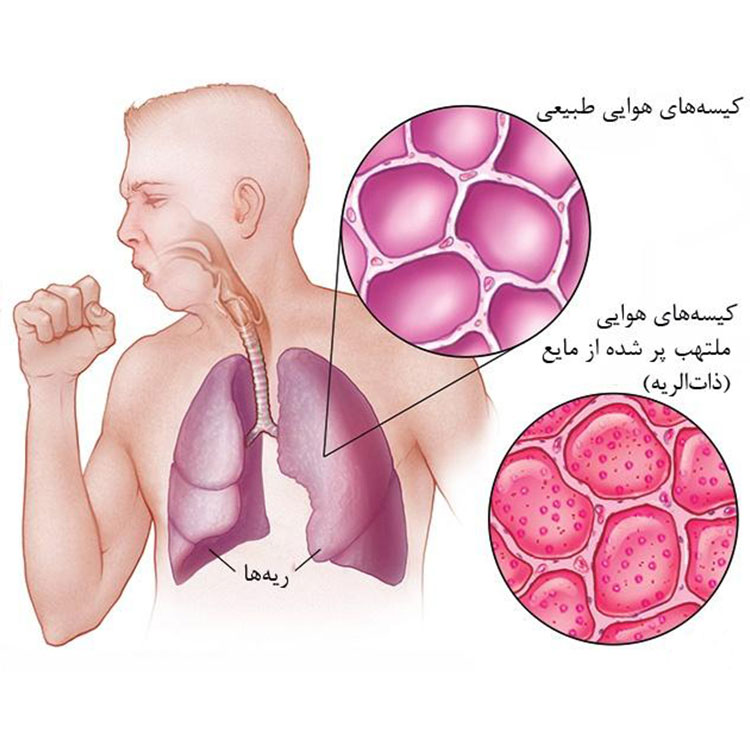 آشنایی با بیماری پنومونی