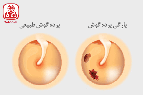 پارگی پرده گوش