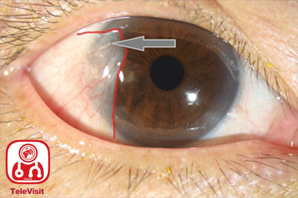 انواع سرطان های چشم