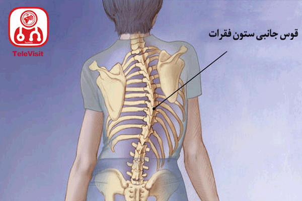 دکسترو اسکولیوز چگونه درمان می شود؟