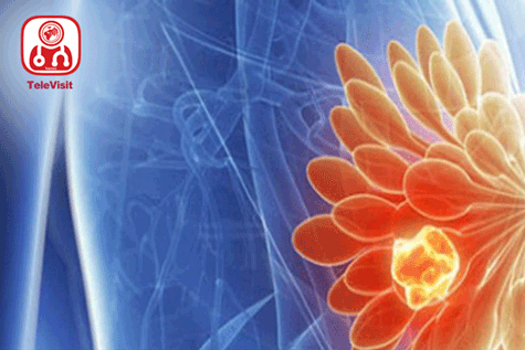 علائم سرطان متاستاتیک پستان