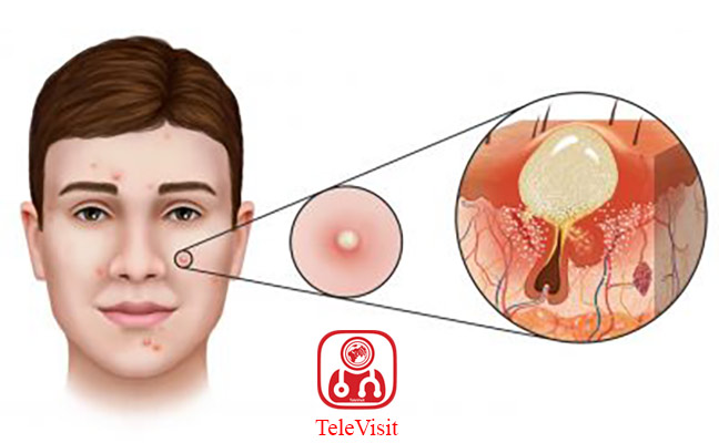 با جوش های چرکی چه کنیم؟