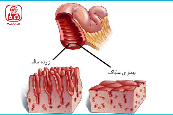 آشنایی بابیماری سلیاک