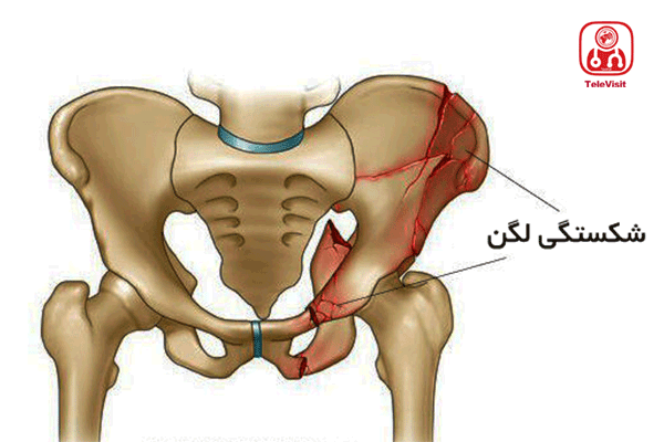 شکستگی لگن و درمان آن