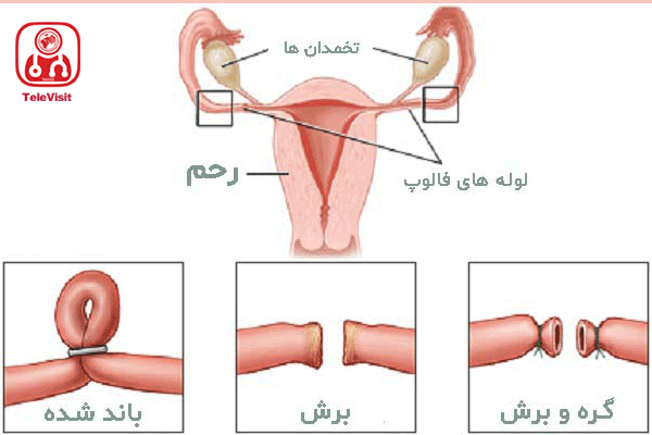 بستن لوله های رحمی در زنان