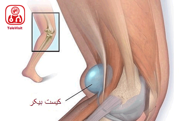 کیست بیکر و درمان آن