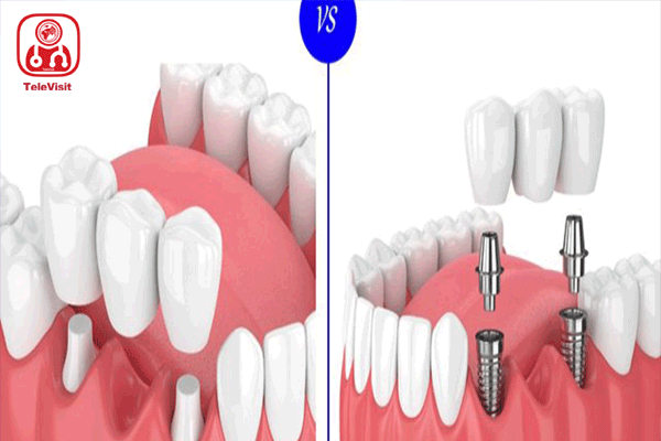 ایمپلنت یا بریج دندان و راههای نگهداری از آن