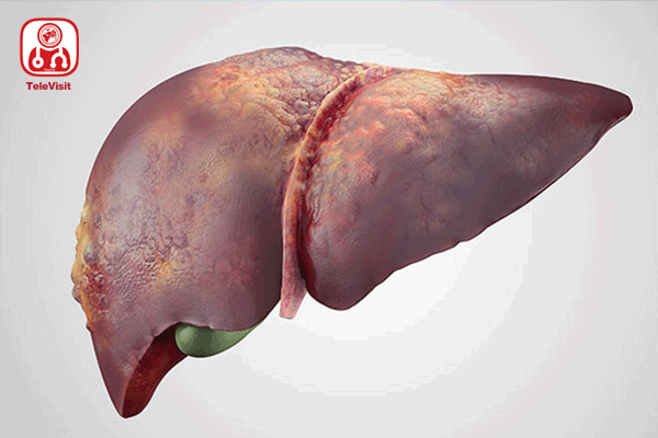آشنایی با فیبروز کبد، از علل تا درمان آن