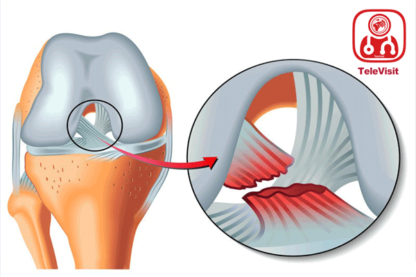 تشخیص و درمان پارگی رباط صلیبی