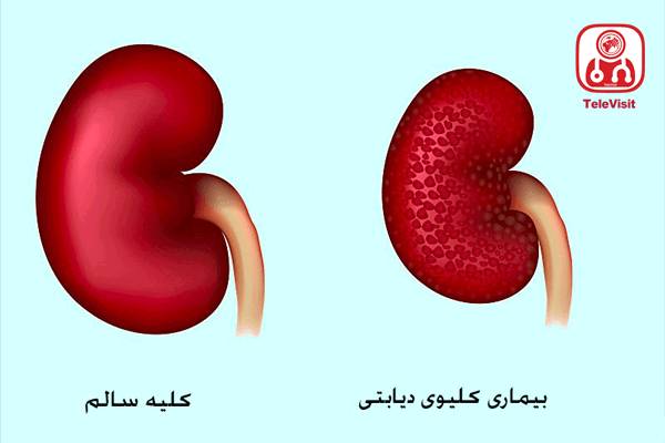 آشنایی با ارتباط دیابت و بیماری های کلیه