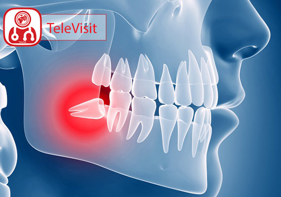 تشخیص و درمان پریکورونیت، ورم و عفونت اطراف دندان عقل