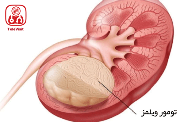 تومور ویلمز، علائم و راهکارهای درمانی آن کدامند؟