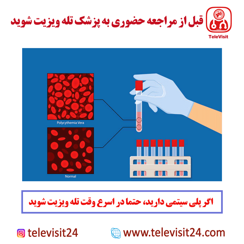 اگر پلی سیتمی دارید، حتما در اسرع وقت تله ویزیت شوید