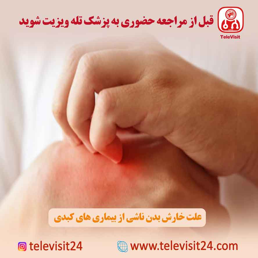 علت خارش بدن ناشی از بیماری های کبدی