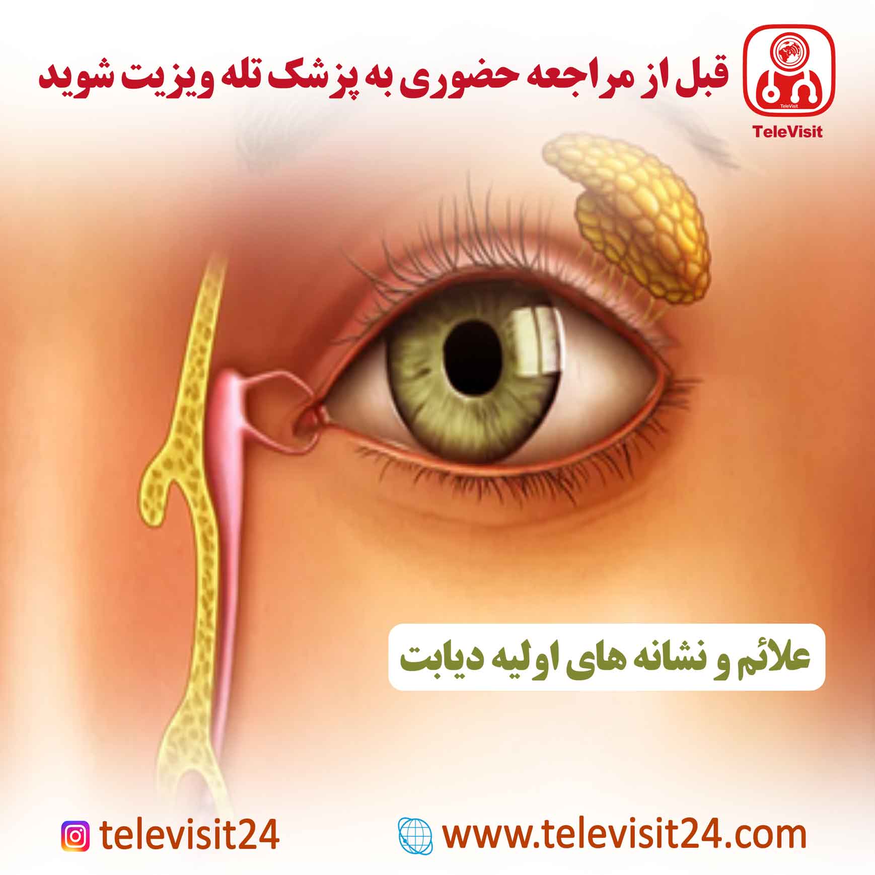 انسداد مجرای اشکی