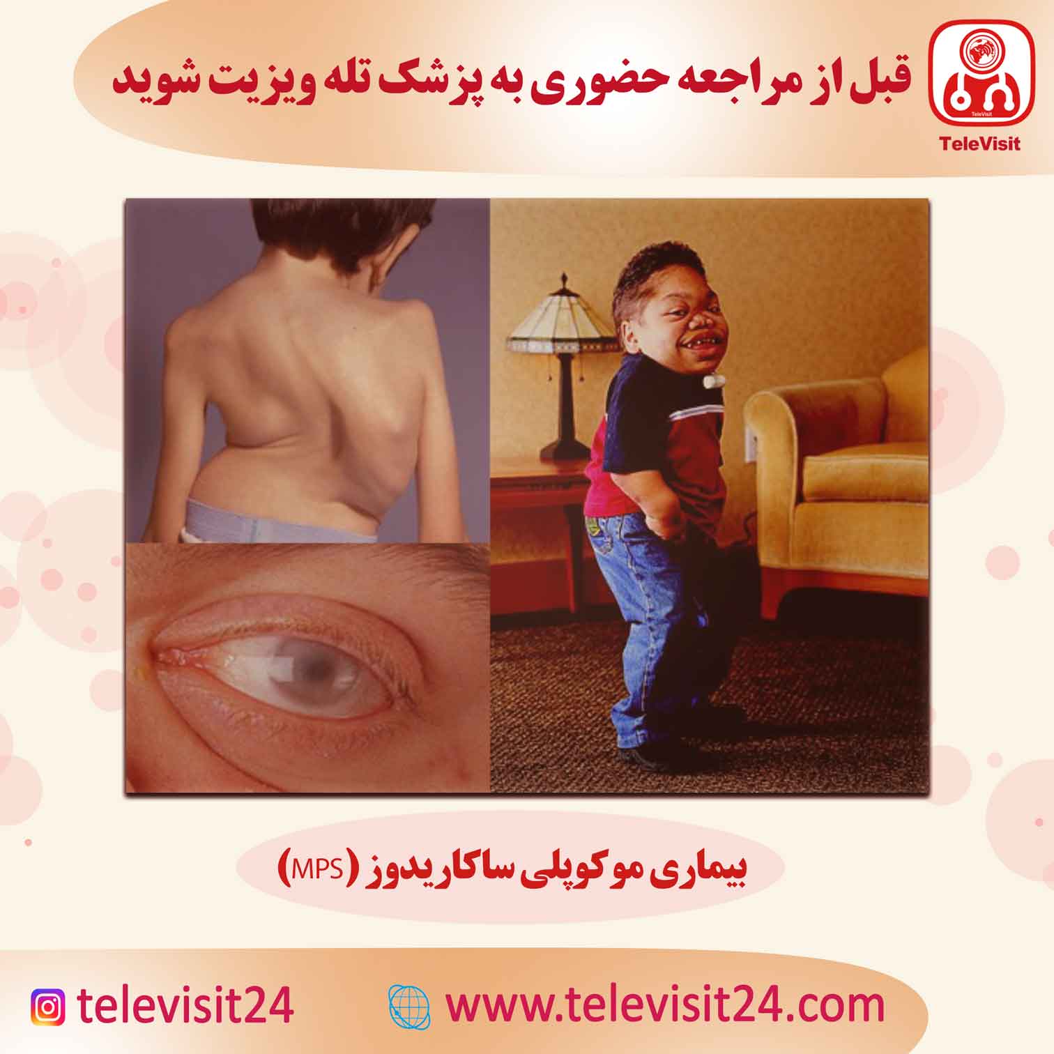 بیماری موکوپلی ساکاریدوز (MPS)