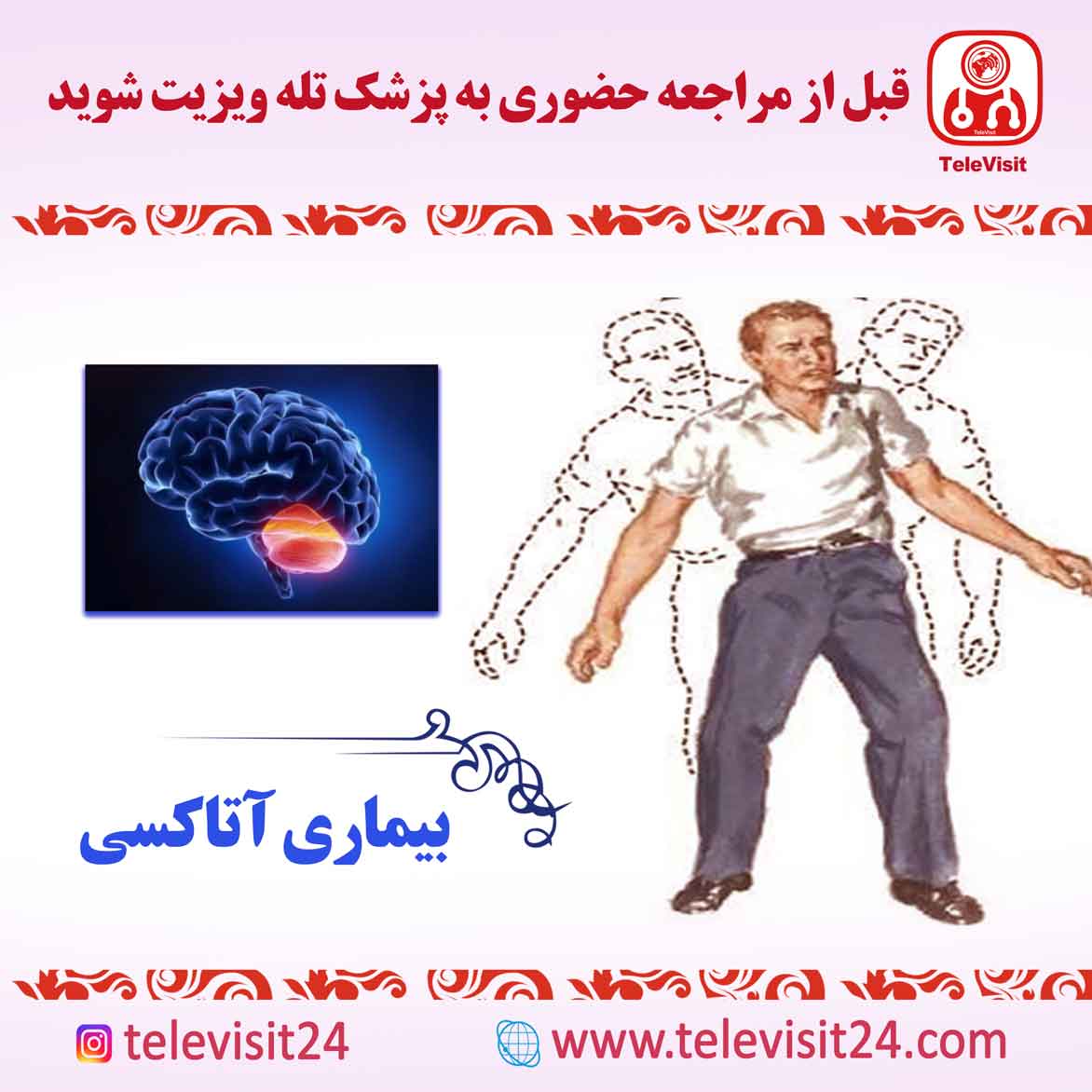 بیماری آتاکسی