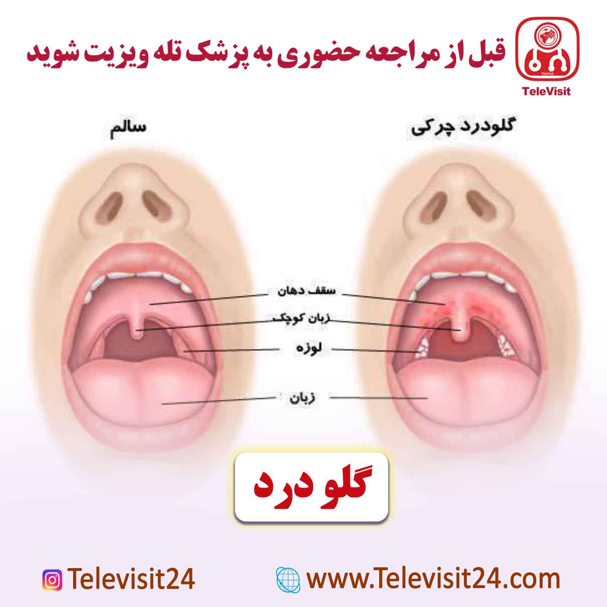گلو درد