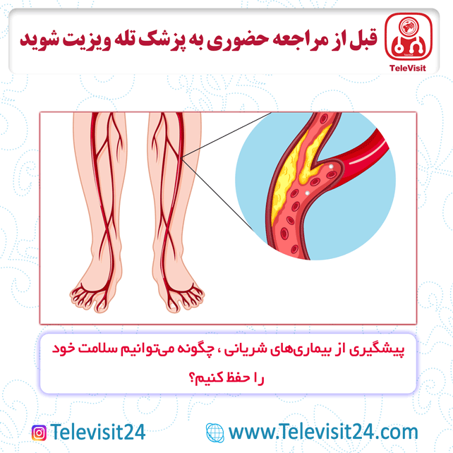 پیشگیری از بیماری‌های شریانی چگونه می‌توانیم سلامت خود را حفظ کنیم؟
