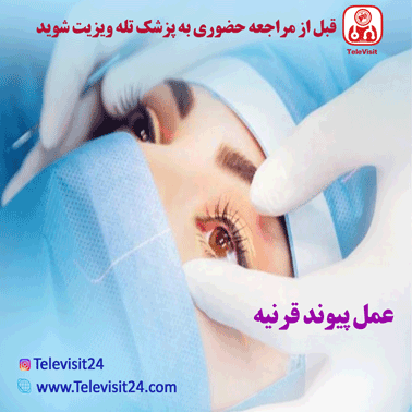 عمل پیوند قرنیه