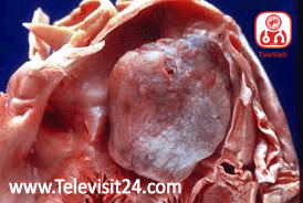 Cardiac Myxoma