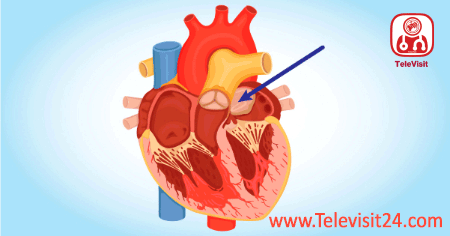 Cardiac Myxoma